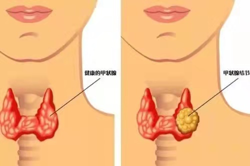 【健康科普】关于甲状腺结节，这几点你需要知道......