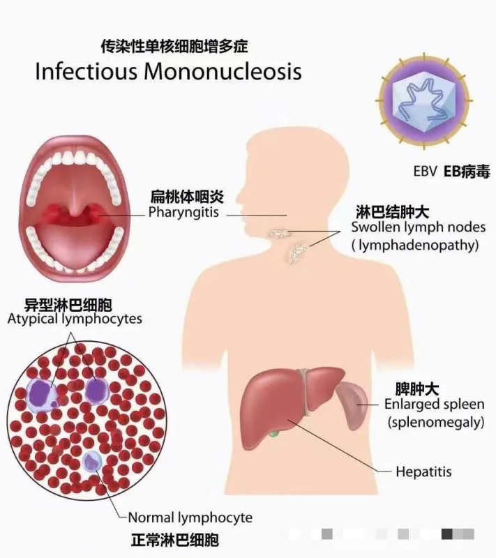 一说到发热、咽痛、扁桃体有“脓性分泌物”，很多家长首先想到的就是化脓性扁桃体炎，然而用了几天抗生素，症状没有缓解，到医院化验后医生告知是“传染性单核细胞增多症”，还具有传染性，这是怎么回事呢？