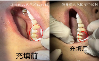 喝冷水、吸冷气时很牙齿酸痛？可能是......